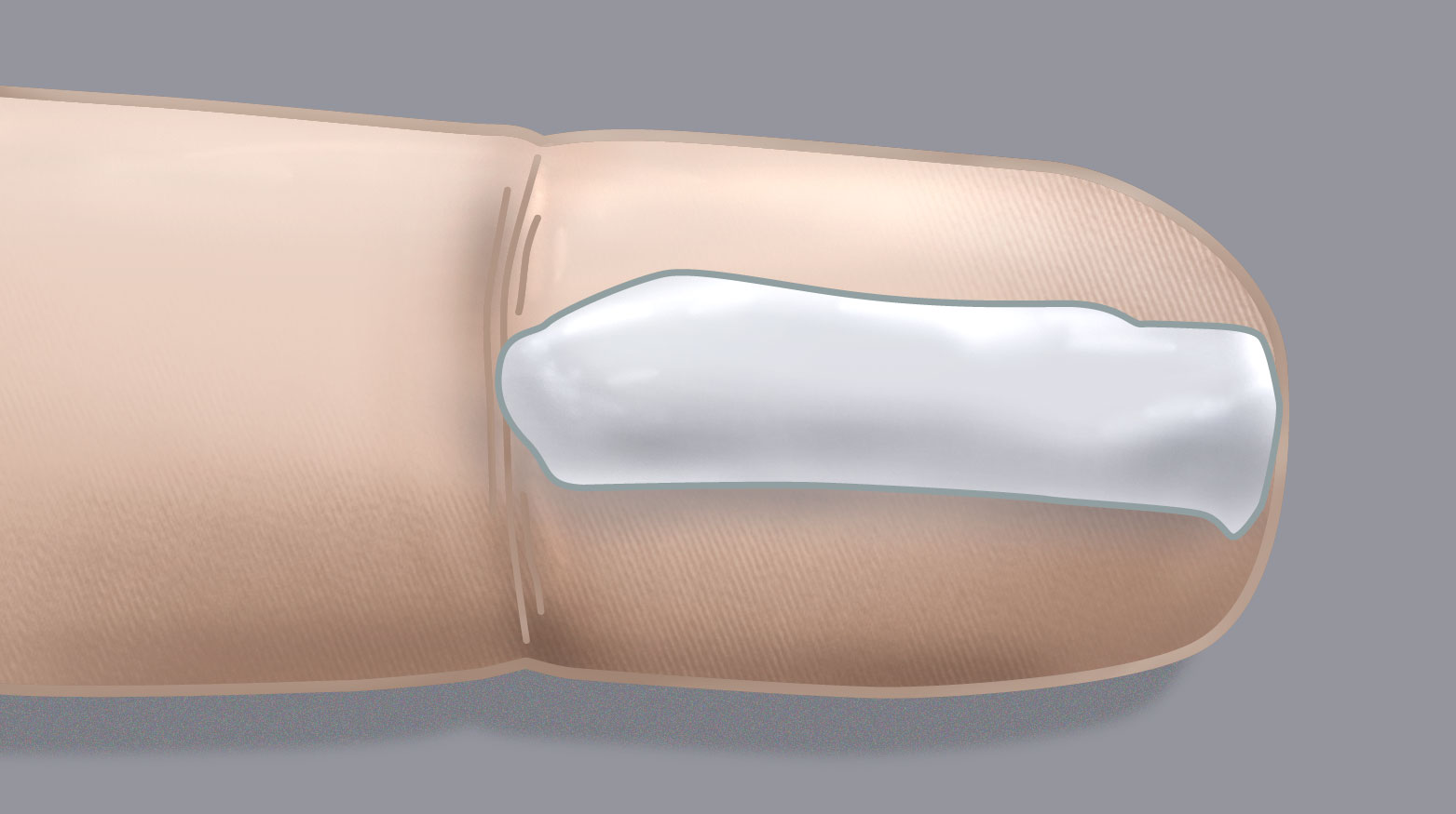 Topical corticosteroids for childhood eczema clearing up the confusion Best Practice Advocacy