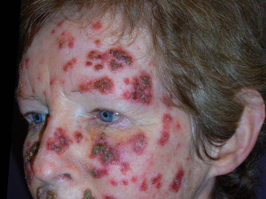 Aldara Cream For Skin Cancer