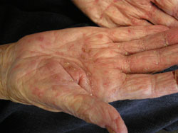 hot shower scabies scabies diagnosis and management bpj 19 february 2009 hot shower scabies scabies diagnosis and management bpj 19 february 2009