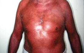 Erythrodermic psoriasis