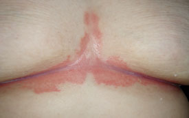 Flexural psoriasis