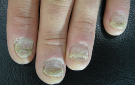 Nail psoriasis Nail psoriasis