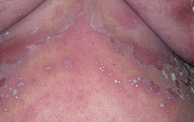 Generalised pustular psoriasis