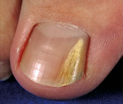 Paronychia Nail Infection - American Osteopathic College ...