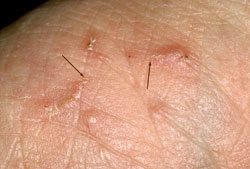 Patient information: Scabies (Beyond the Basics) - UpToDate