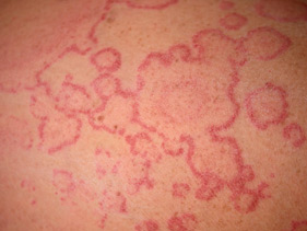 urticaria_annular pattern