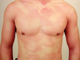 Urticarial lesions: If not urticaria, what else? The ...