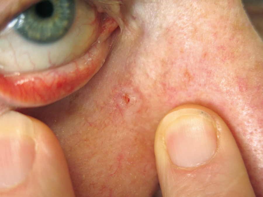Picture of Basal Cell Carcinoma on the Nose - WebMD