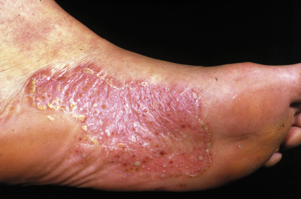 dermnet nz psoriasis