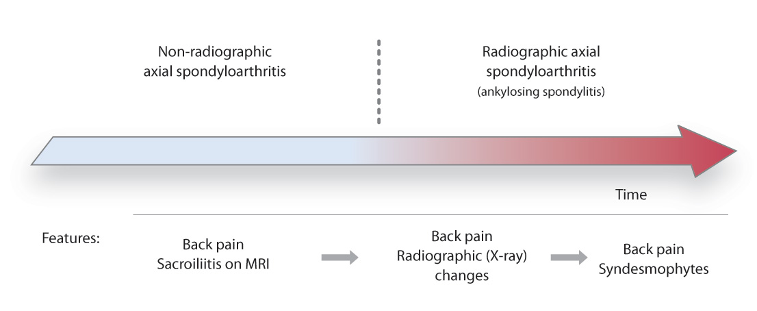 Diagnosis and management of axial spondyloarthritis in