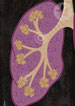 COPD