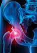 Osteoarthritis