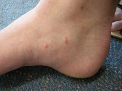 hot shower scabies best practice 19 february 2009 scabies diagnosis and hot shower scabies best practice 19 february 2009 scabies diagnosis and