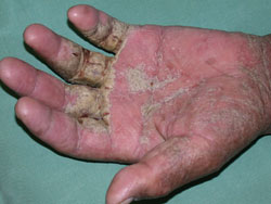 hot shower scabies best practice 19 february 2009 scabies diagnosis and hot shower scabies best practice 19 february 2009 scabies diagnosis and
