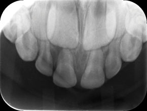 Primary Tooth Abscess