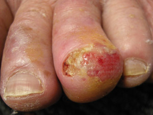 Acral lentiginous melanoma, © DermNet NZ Acral lentiginous melanoma, © DermNet NZ