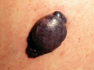 Nodular melanoma, © DermNet NZ Nodular melanoma, © DermNet NZ